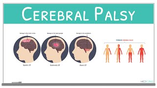 Cerebral Palsy classification, causes, signs and symptoms and treatment