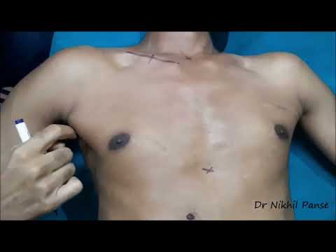 PMMC Flap - Planning