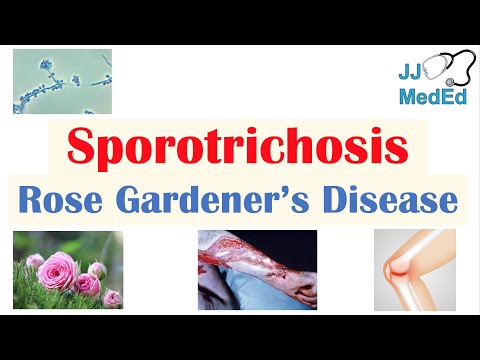 Schistosomiasis Bilharziasis Causes Symptoms and Treatment