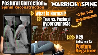Postural Correction in Spinal Reconstruction | Warrior1Spine