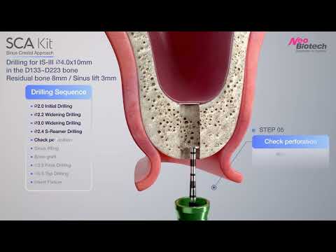 SCA Kit｜Sinus lift   Crestal approach with bone graft｜Procedure Neobiotech
