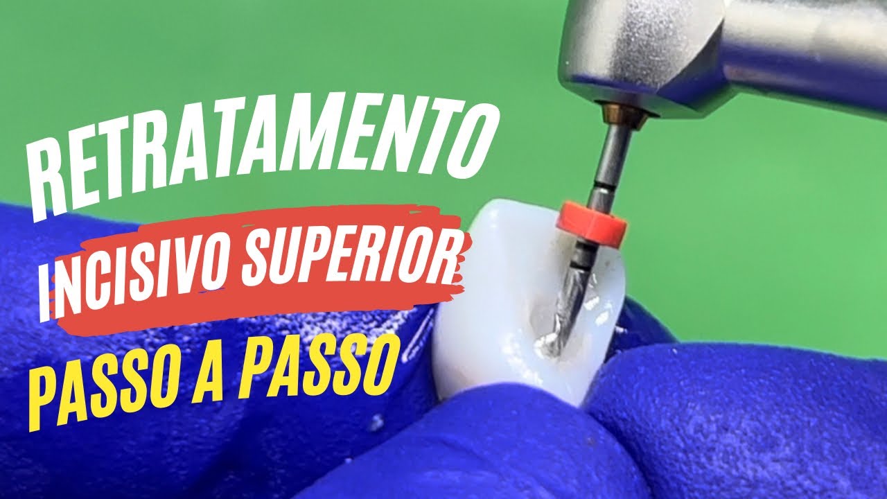 RETRATAMENTO INCISIVO SUPERIOR [SEM USAR SOLVENTE QUE CAUSA DOR!!] - PASSO A PASSO Endolovers
