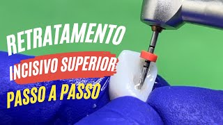 RETRATAMENTO INCISIVO SUPERIOR [SEM USAR SOLVENTE QUE CAUSA DOR!!] - PASSO A PASSO Endolovers