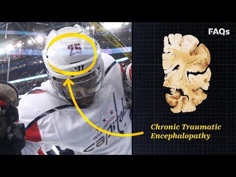 CTE: Why this brain disease is more common than you think