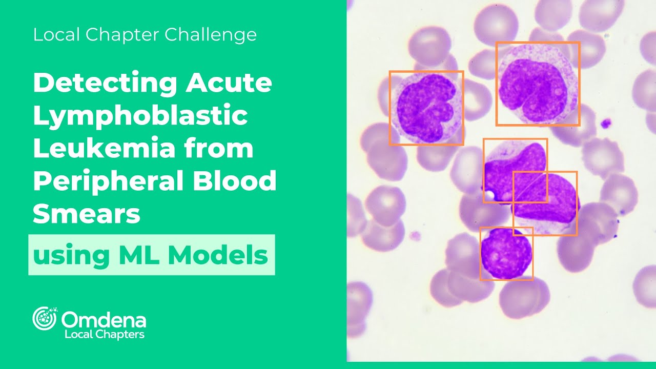 Acute Lymphoblastic Leukemia (ALL) Detection Using Deep Learning Models from PBS Images