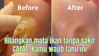 Download lagu Cara Alami menghilangkan mata ikan di bawah kaki pakai bawang putih | bawang putih untuk mata ikan mp3