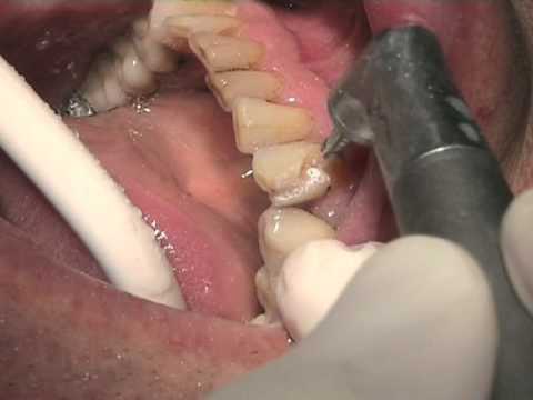 comment soigner carie