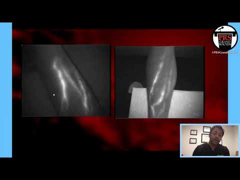 PRS Grand Rounds : Microsurgery & Supermicrosugery in Lymphedema Treatment