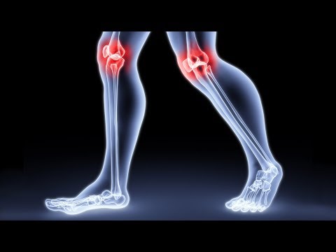 kenőcsök a lábízületek kezelésére retropatellaris artrózis kezelés