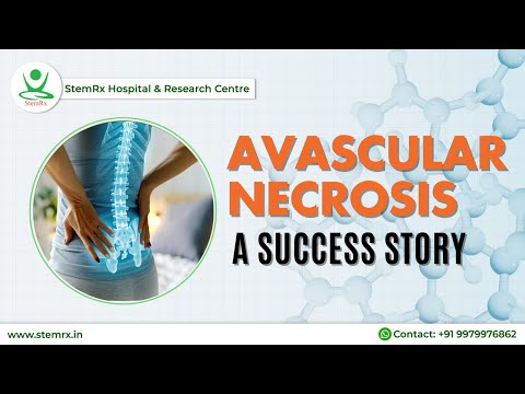 Understanding Avascular Necrosis: Stem Cell Treatment & Information | AVN Guide