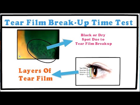 Tear Film Break-up Time Test (Within 1:30 min)