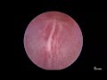 Core Videos (2021): Posterior Urethral Valve Ablation