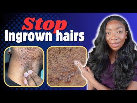 Doctor's Secret to Never Getting an Ingrown Hair Again