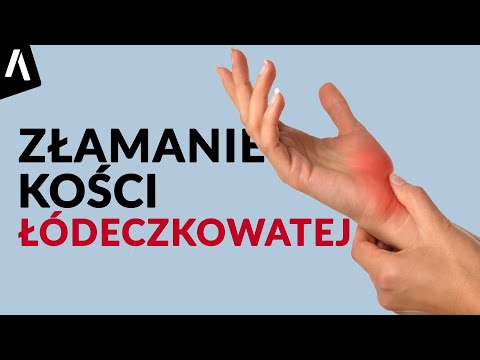 Złamanie kości łódeczkowatej I Jak długo zrasta się kość łódeczkowata?