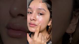 How To Get Rid Of Acne On Cheeks | Causes And Treatment For Acne | Be Beautiful #Shorts