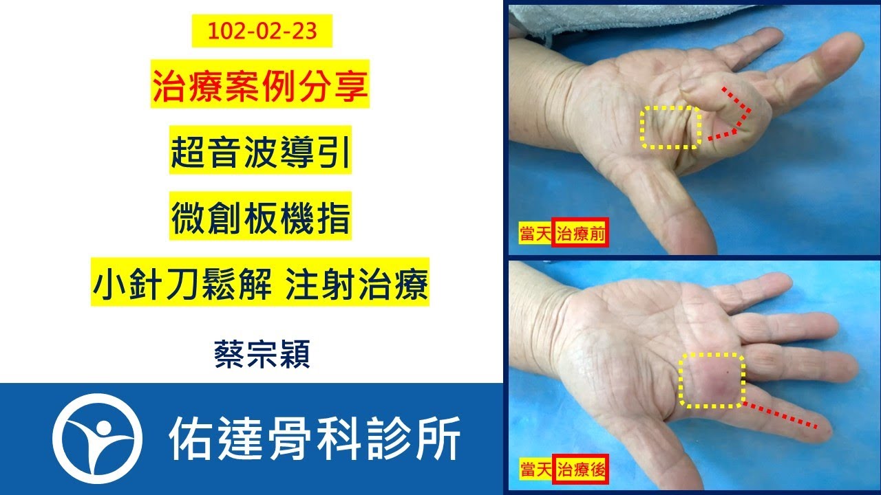 超音波導引 微創板機指 小針刀鬆解 注射治療：治療案例分享【佑達骨科】【蔡宗穎醫師】 - AI健康醫療影片