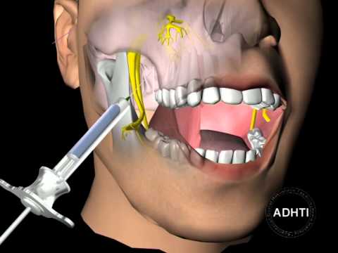 Инфильтрационная анестезия верхней челюсти
