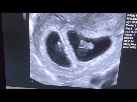 Sonogram: Twins at 7 weeks gestation!