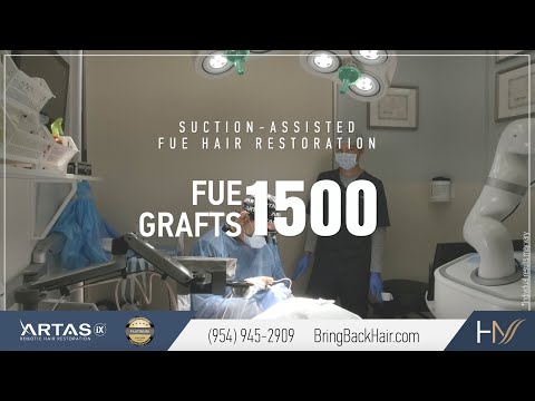 1500 FUE NeoGraft Hair Transplant Procedure for African-American Patient, Boca Raton, Fl