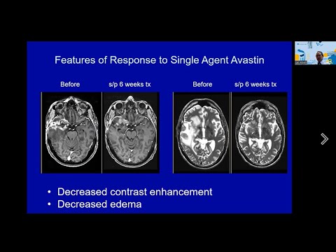 Chemotherapies and Biologic Agents in Treatment of Gliomas: UCLA Brain Tumor Virtual Conference 2022
