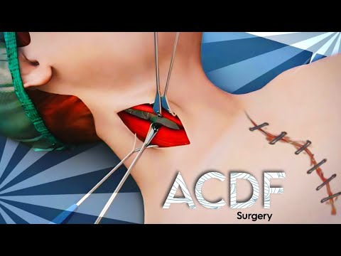 ACDF (Anterior Cervical Discectomy and Fusion) 3D Animation