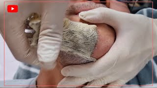 Download lagu Beard Hair Pulling Hair Waxing Stress Relief Pleasure Skin Beauty Skin Care Men 수염왁싱 털뽑기 #shorts mp3