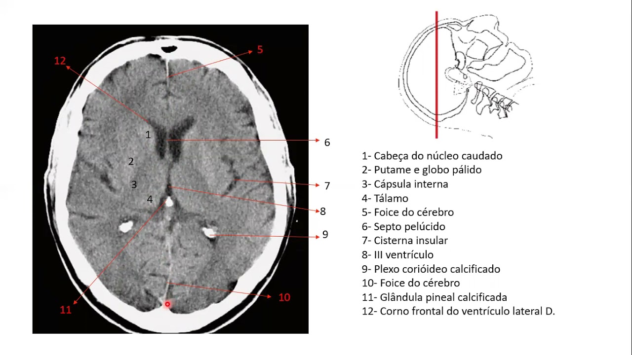 Encéfalo por imagens de tomografia
