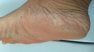 How to get rid of dry cracked, crusty feet