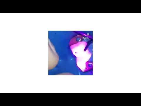 Désinfection laser sur une 16 (PARTIE 2) – Endodontie