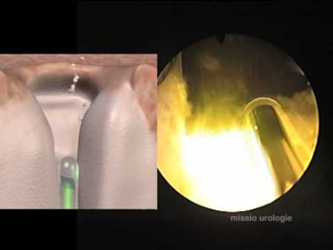 Prostate Vaporisation - Green Light Laser Technique