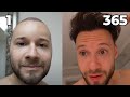 My Conclusion 365 Days Hair Transplant