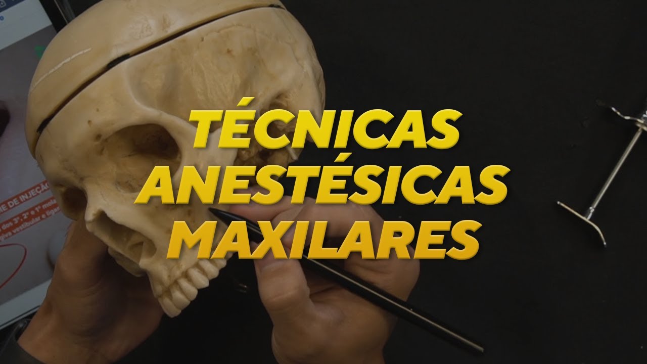 TÉCNICAS ANESTÉSICAS MAXILARES | CIRURGIA