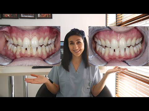 YouTube video about: Which describes the typical procedure during a dental cleaning?