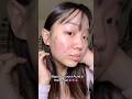 How I knew my acne was Hormonal 🥲 #acne #hormonalacne #acnejourney #viral