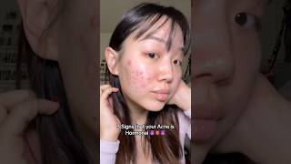 Download lagu How I knew my acne was Hormonal 🥲 #acne #hormonalacne #acnejourney #viral mp3 Download lagu How I knew my acne was Hormonal 🥲 #acne #hormonalacne #acnejourney #viral mp3