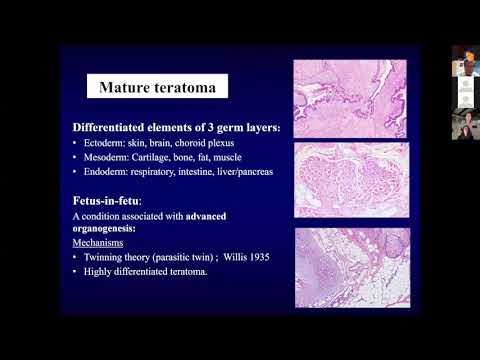 CNS Germ Cell Tumors in Children