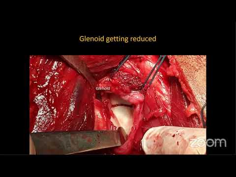 Webinar 32- Clavicle -Ac Joint - Scapula Part 1 and 2 videos