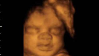 preview picture of video '32 weeks yawning.http.//www.windowtothewomb.co.uk  Beautiful 4D baby bonding scan'