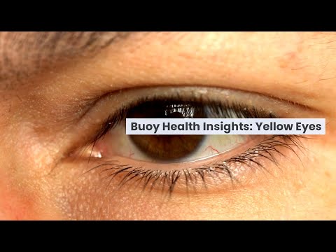 Yellow Eyes: Common Causes and When to Seek Medical Care  | BuoyHealth.com