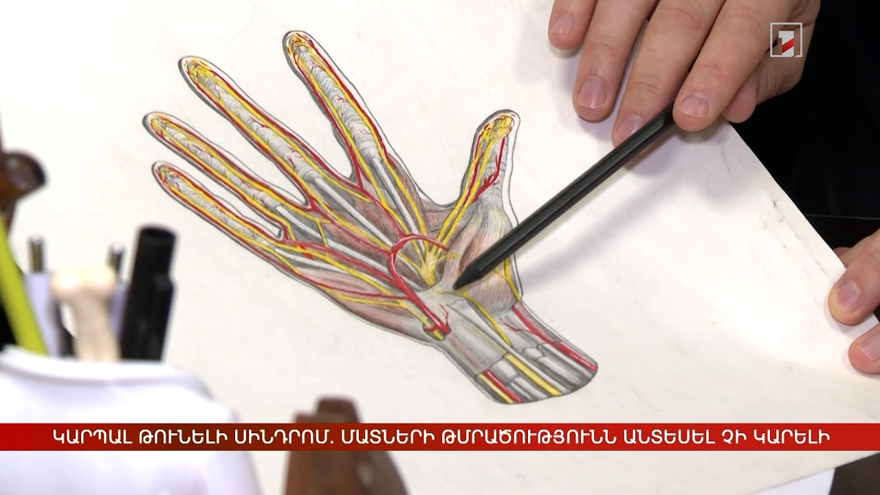 Կարպալ թունելի համախտանիշ. մատների թմրածությունն ու թուլությունն անտեսել չի կարելի