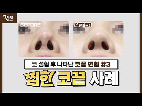 [실제 사례] 빨래 집게로 집어 놓은 듯한 찝힌 코｜#코끝변형 #코끝｜해결 방법 大공개!