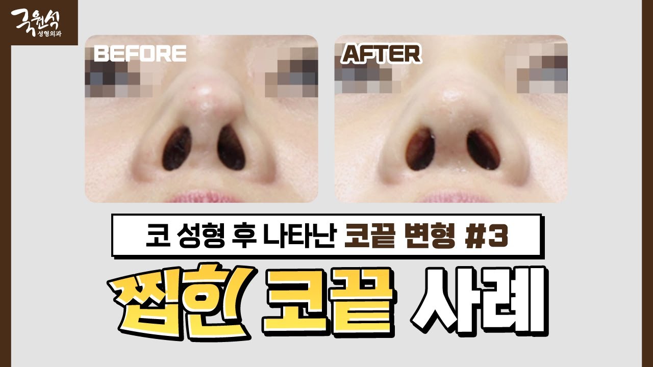 [실제 사례] 빨래 집게로 집어 놓은 듯한 찝힌 코｜#코끝변형 #코끝｜해결 방법 大공개! 썸네일
