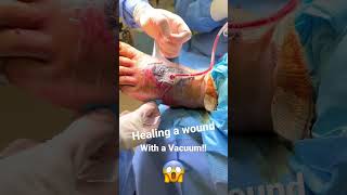How wounds are healed!😱 #shorts
