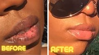 How I Treat My Lip Discoloration | 2021 Lip Routine To Save Money