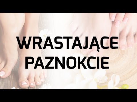 Co koślawe stopy Koślawe kolana u dzieci 8 lat