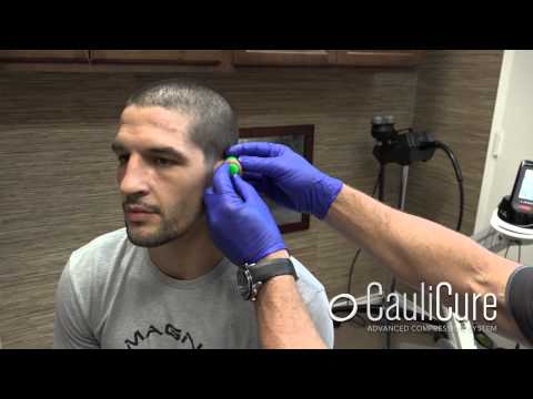 How to use CauliCure for the prevention of Cauliflower ear