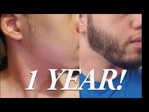 1 year of Minoxidil to grow a Beard [BEARD TIMELINE]