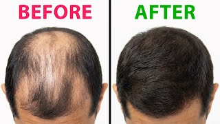 These Are The BEST Foods For Hair Loss
