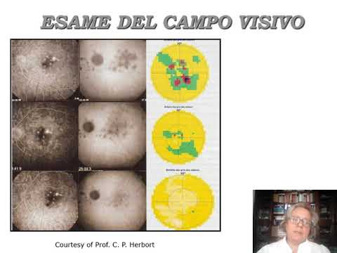 Congresso  - Coriocapillaropatie