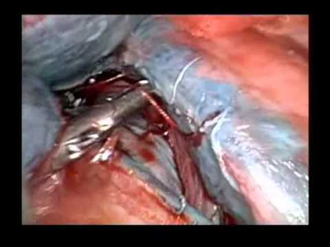 Torakoskopowe i endoskopowe zaopatrzenie perforacji przełyku powstałej w wyniku wprowadzania zgłębnika do żołądka po wytworzeniu zepolenia omijającego Roux-en-Y